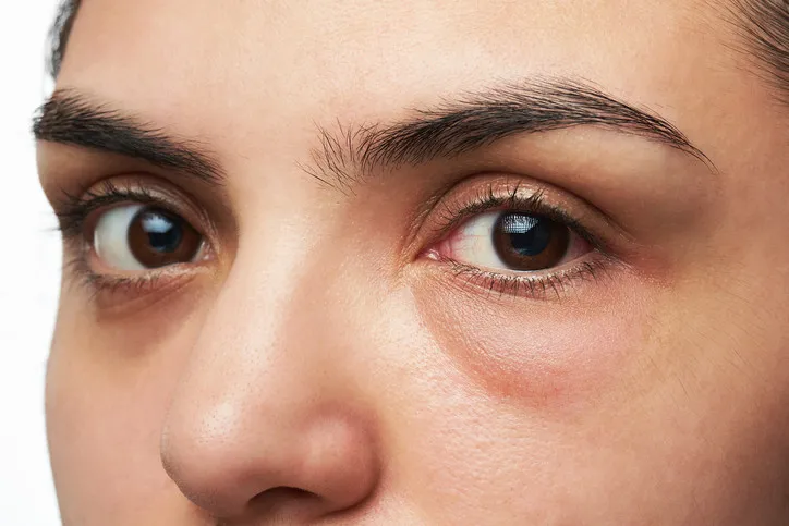Cómo tratar el contorno de los ojos para evitar ojeras, bolsas y arrugas