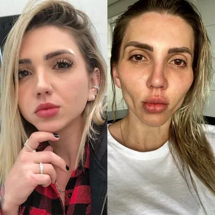 Influencer de TikTok se desfigura el rostro tras someterse a una bichectomía