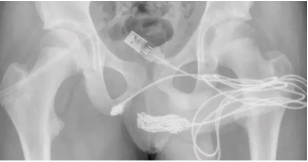 Joven se introduce cable USB en el pene