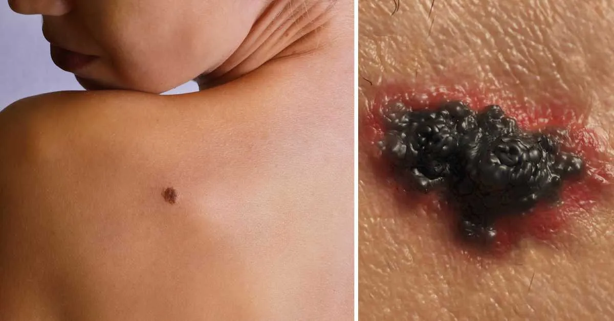 Descubren un mecanismo que causa la metástasis del melanoma y cómo frenarlo