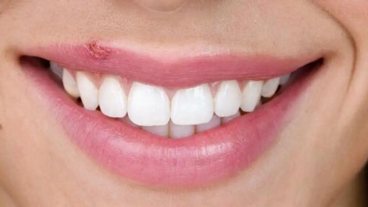 Cómo evitar y tratar el herpes labial