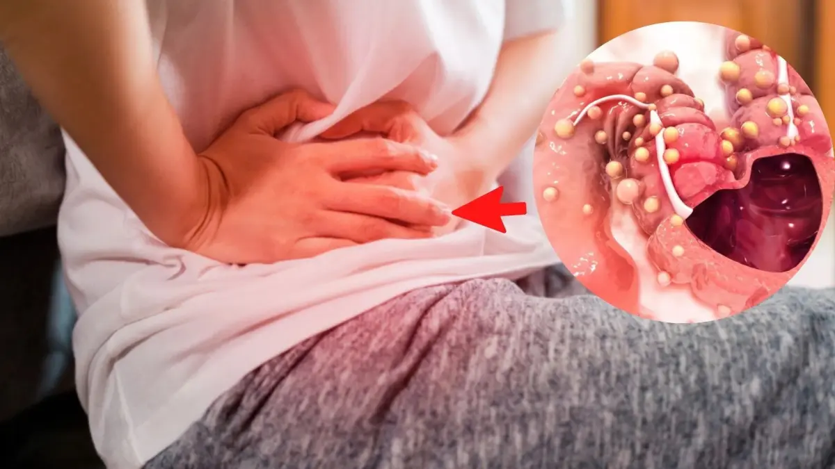 El 90 % de los casos de cáncer de colon tiene cura si se detecta a tiempo