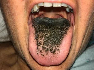 Descubren nueva enfermedad denominada “síndrome de lengua peluda negra