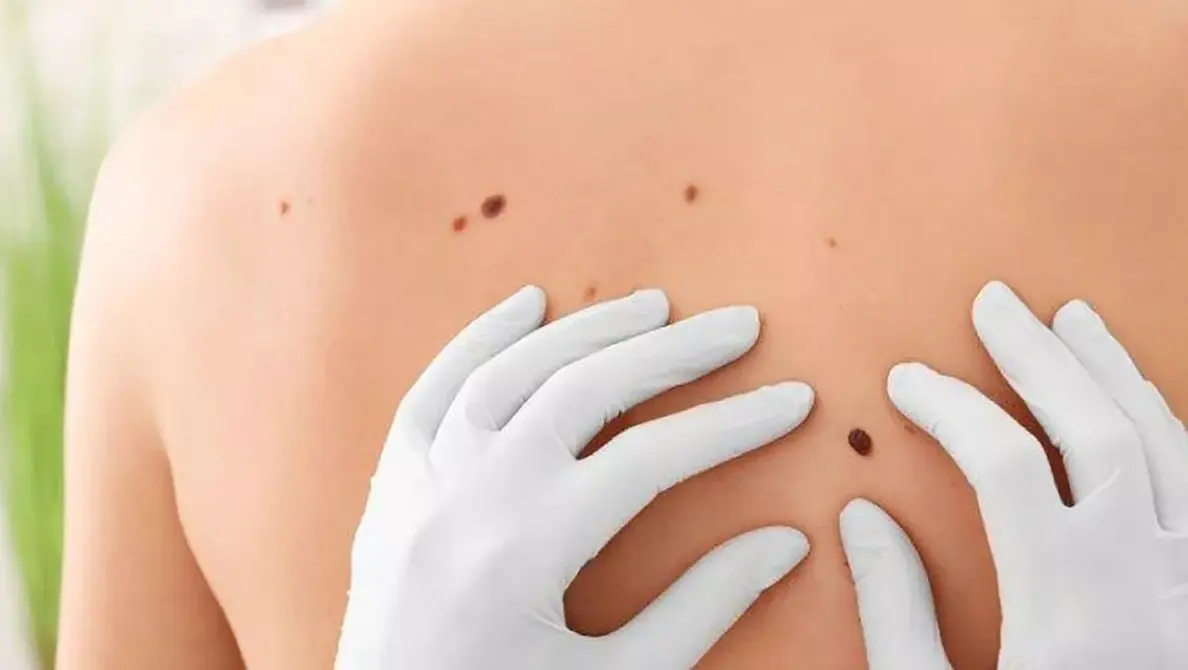 Descubre cómo prevenir el cáncer de piel más grave llamado Melanoma