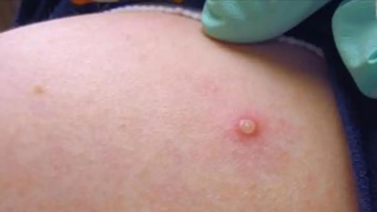 Salud Pública: No hay transmisión comunitaria de la viruela del mono en el país