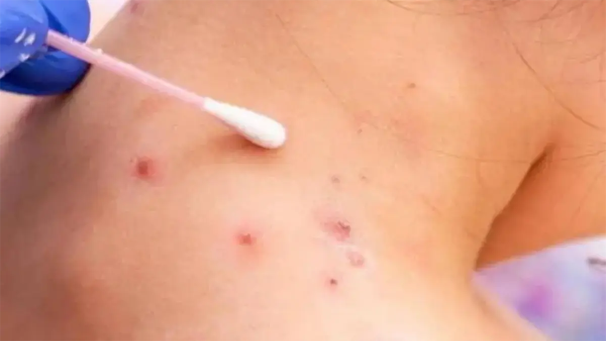 Haití emite alerta por presencia de viruela del mono en territorio dominicano