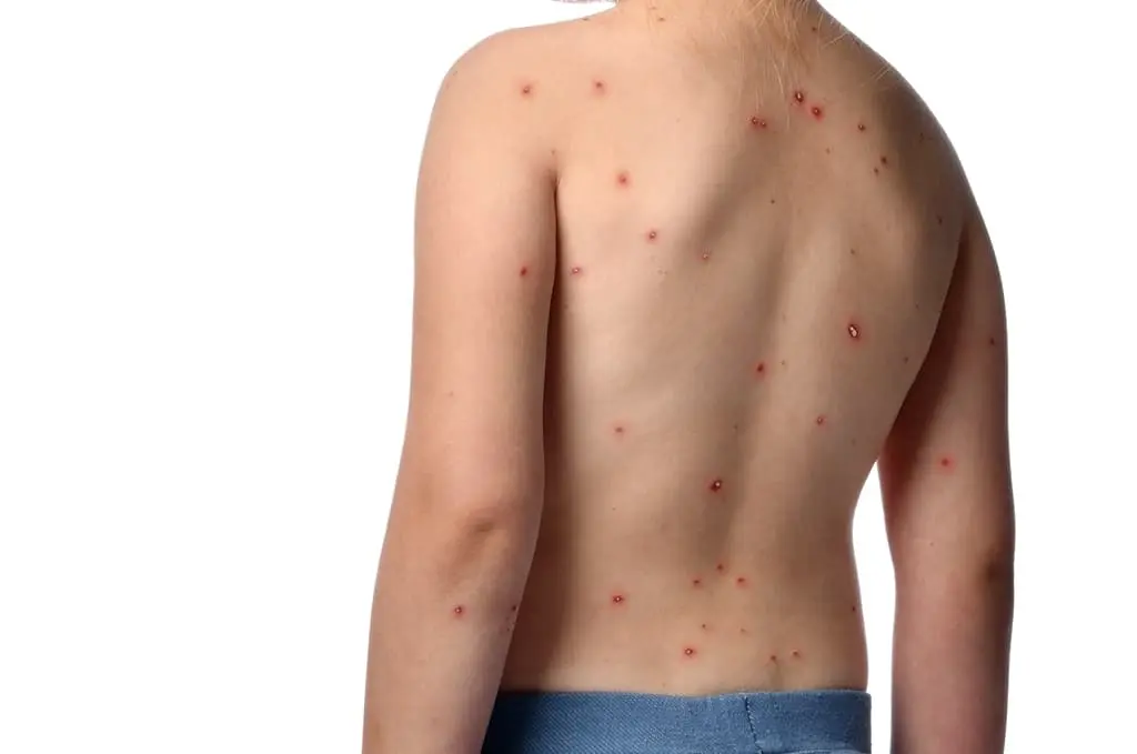 Nueva York acumula mil casos de viruela del mono, casi un tercio de todo EEUU