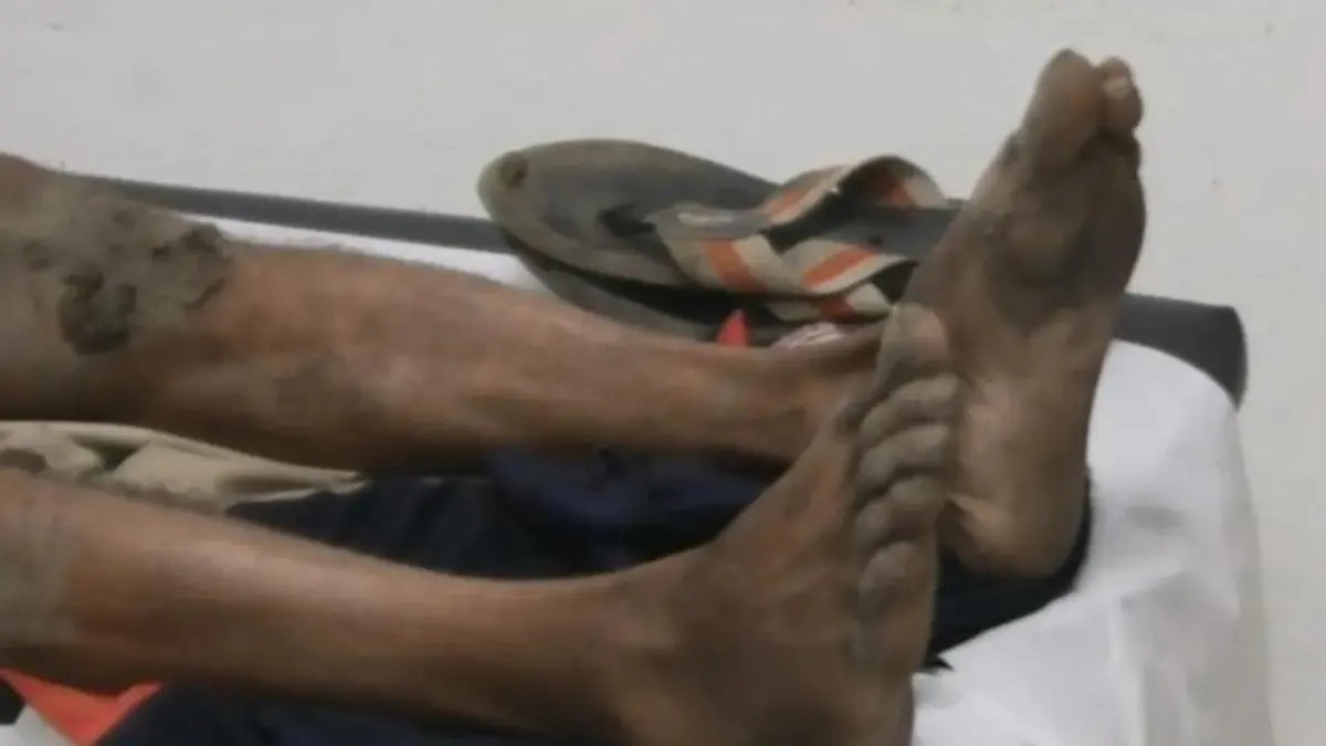 Muere hombre tras ser quemado supuestamente por su esposa