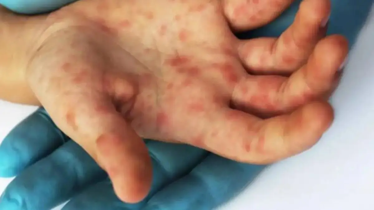 Confirman primera muerte a causa de la viruela del mono en Perú