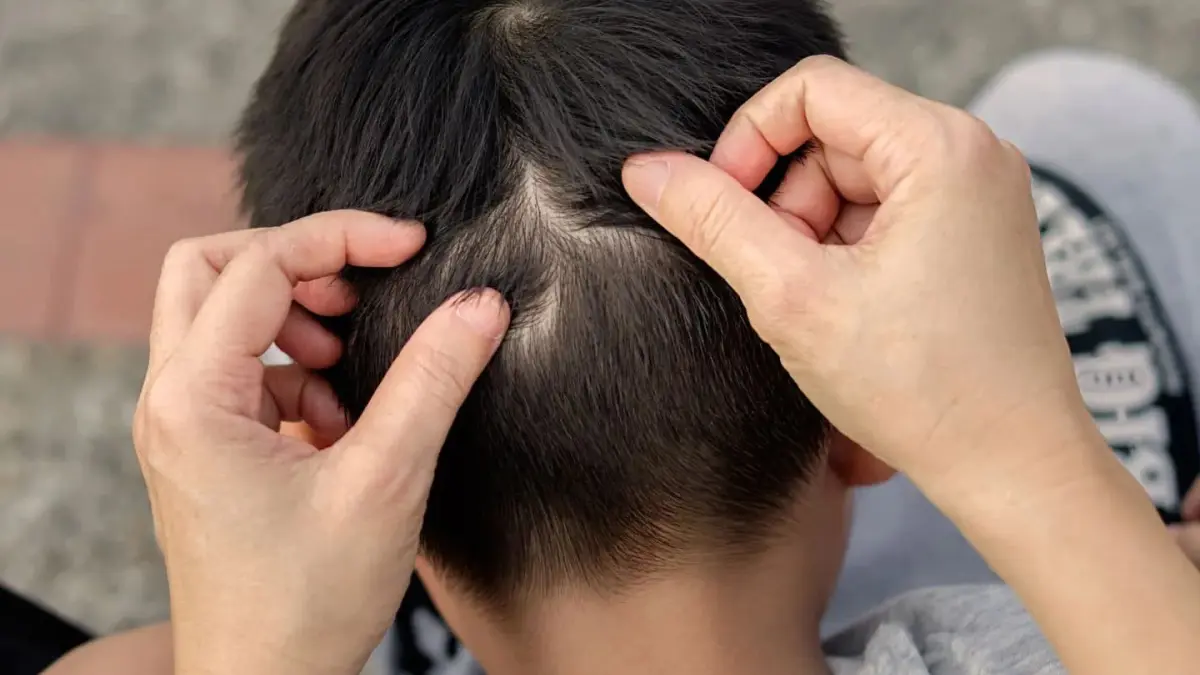 Un bebe de 5 meses tiene piojos ¿Cómo curarlo sin hacerle daño a su salud?