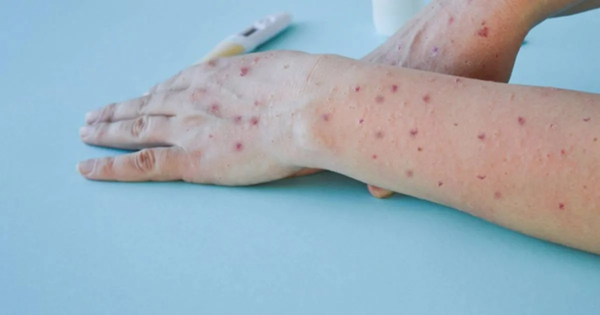 México reporta 284 nuevos contagios de viruela del mono y totaliza 788