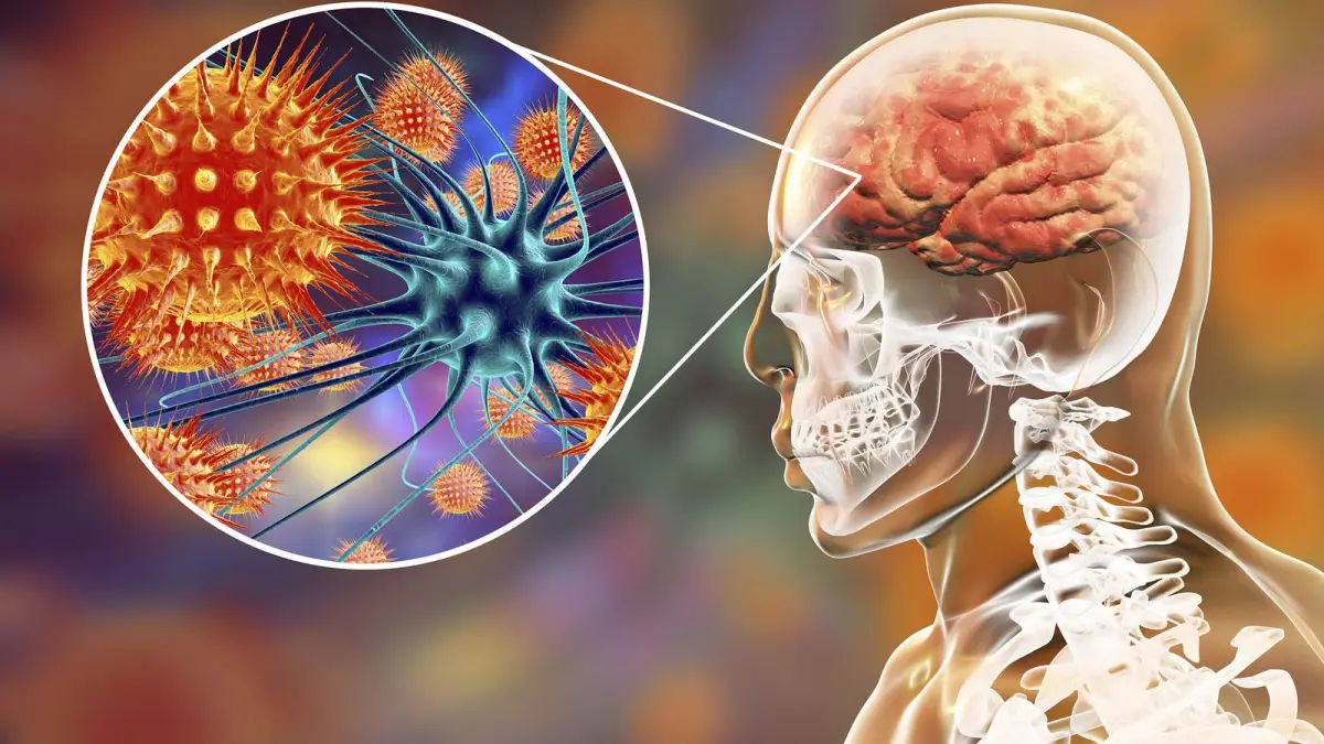 Una de cada 5 personas que sobreviven a la meningitis bacteriana pueden tener secuelas graves