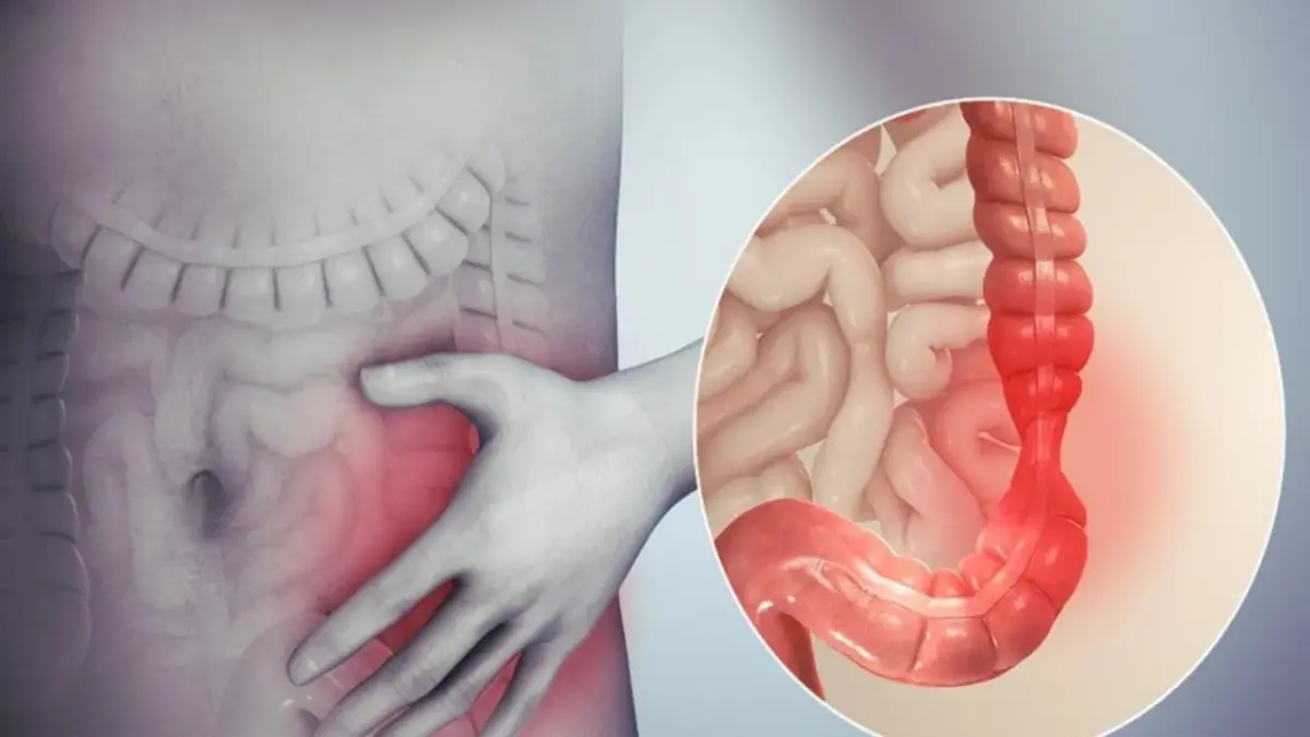 Enfermedad inflamatoria intestinal y síndrome de colon irritable: ¿Son lo mismo?
