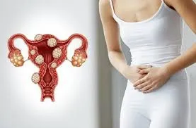 Me detectaron un mioma ¿Debo preocuparme?