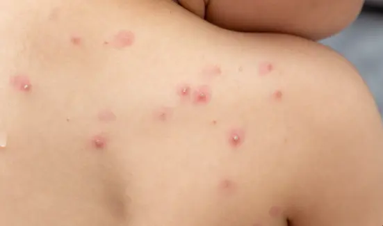 Panamá detecta 11 casos más de viruela símica y acumula un total de 110