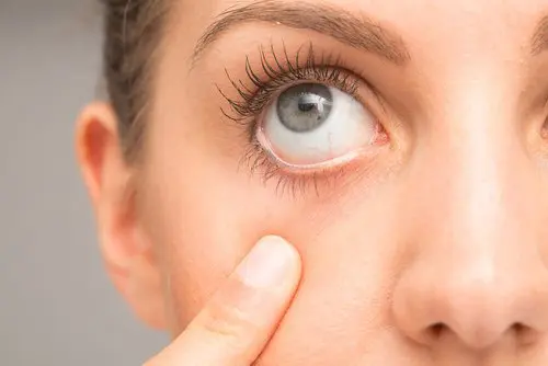 Cómo diferenciar la alergia ocular del ojo seco