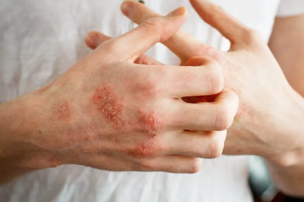 Hoy se celebra el Día Mundial de la Dermatitis Atópica