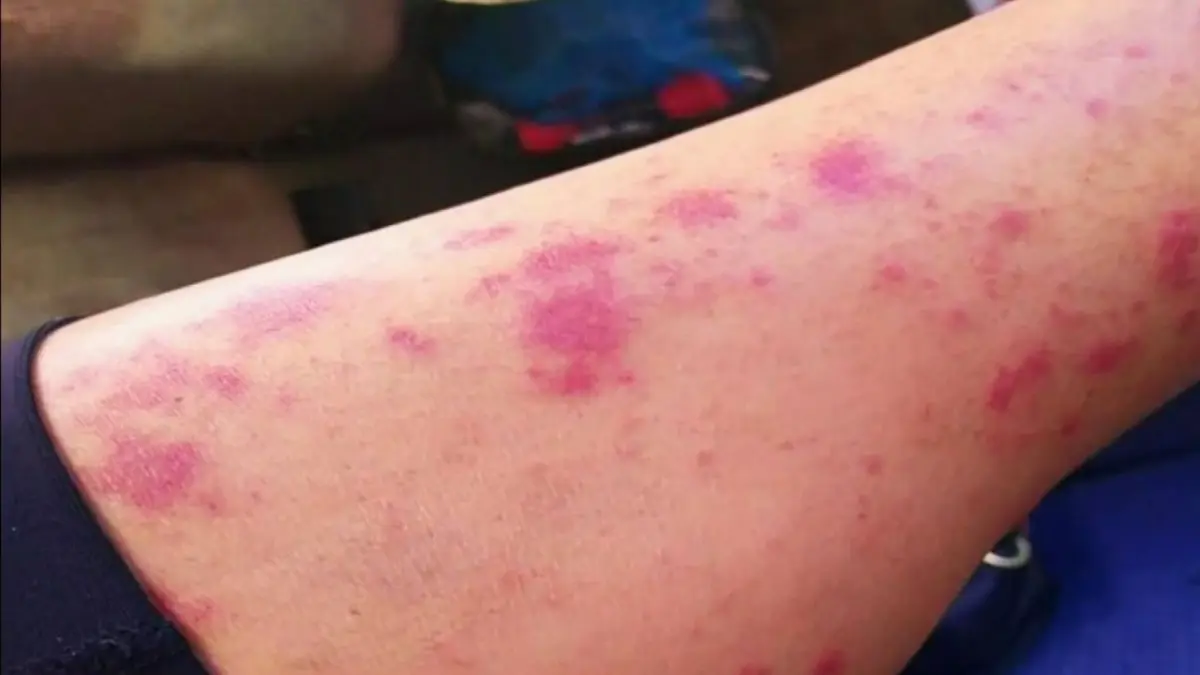 EE.UU. alerta de mortífera bacteria come carne en aguas del Atlántico