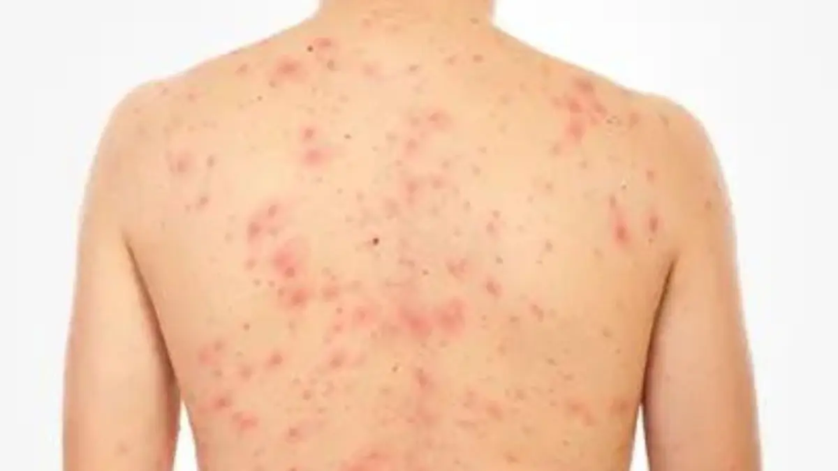 Salud Pública emite alerta epidemiológica por sarampión