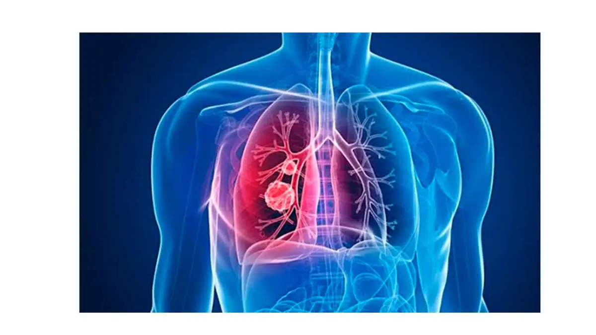 Identifican diana terapéutica para salvar el corazón de pacientes con hipertensión pulmonar