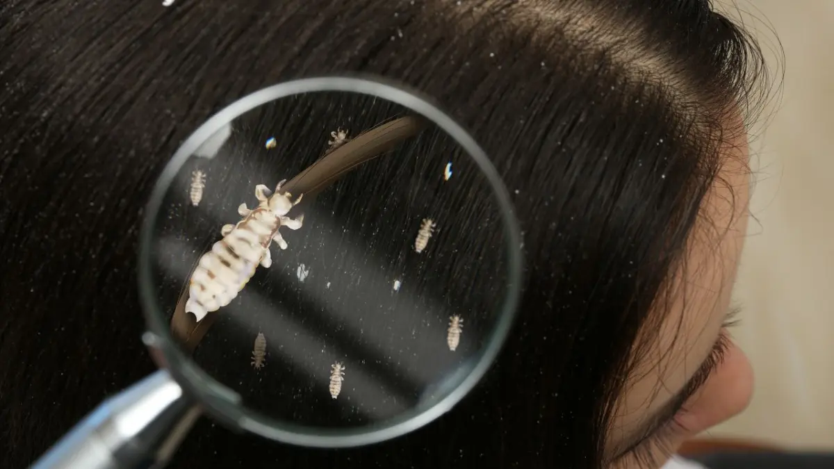 Descubren que los piojos del cuerpo humano son potentes transmisores de la peste