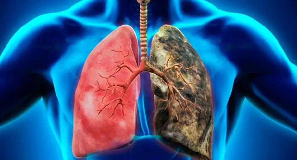 ¿Cuáles son los síntomas del cáncer de pulmón?