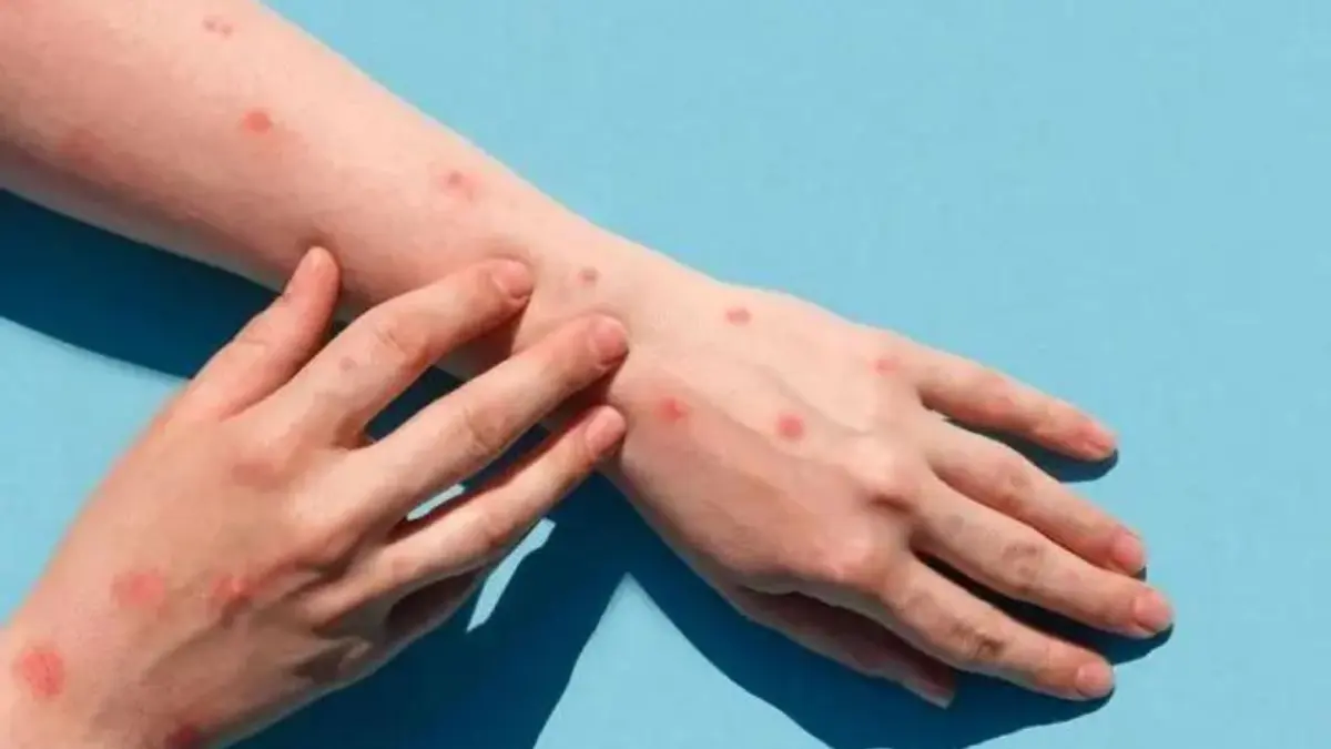 Director OMS: con liderazgo de los gobiernos, el brote de mpox puede terminar en 6 meses