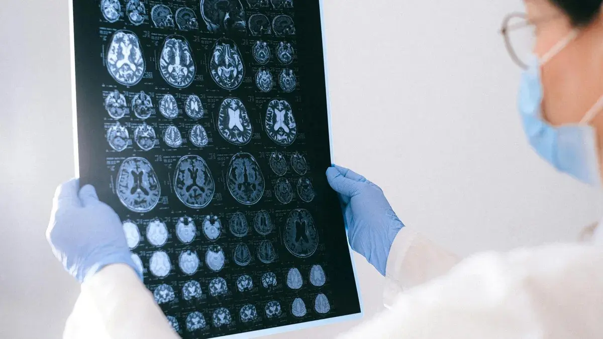 Identifican cambios tempranos en el cerebro que podrían anticipar el riesgo de alzhéimer