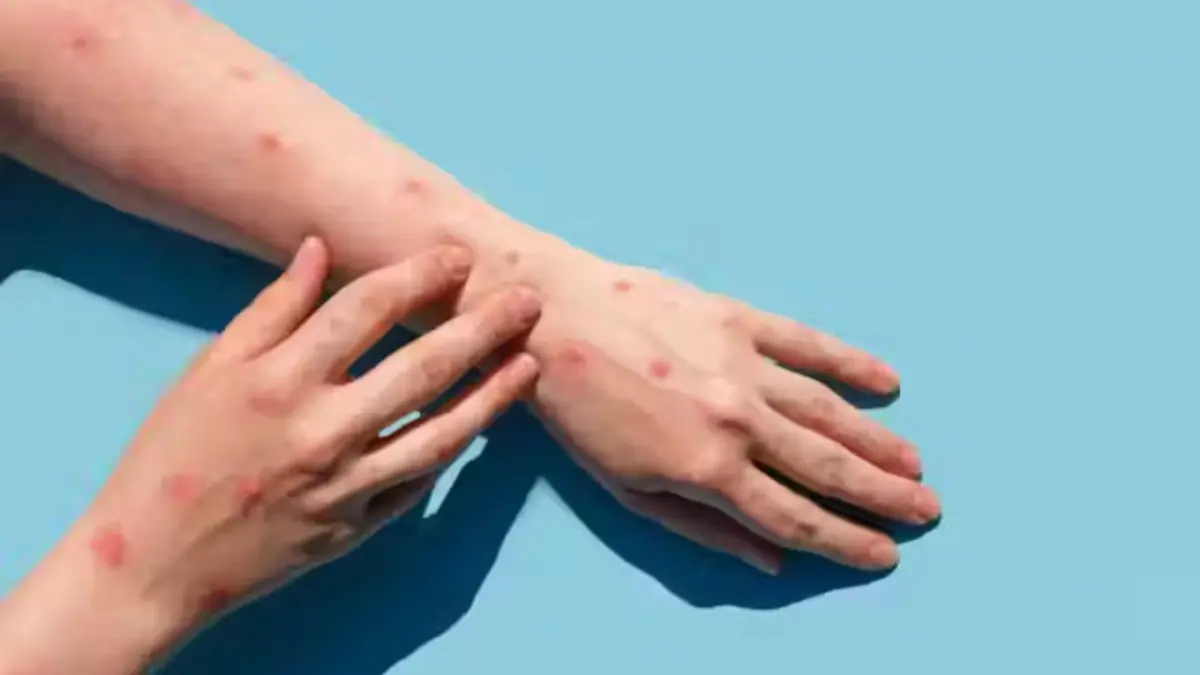 MP dice no hay casos confirmados de “viruela del mono” en RD