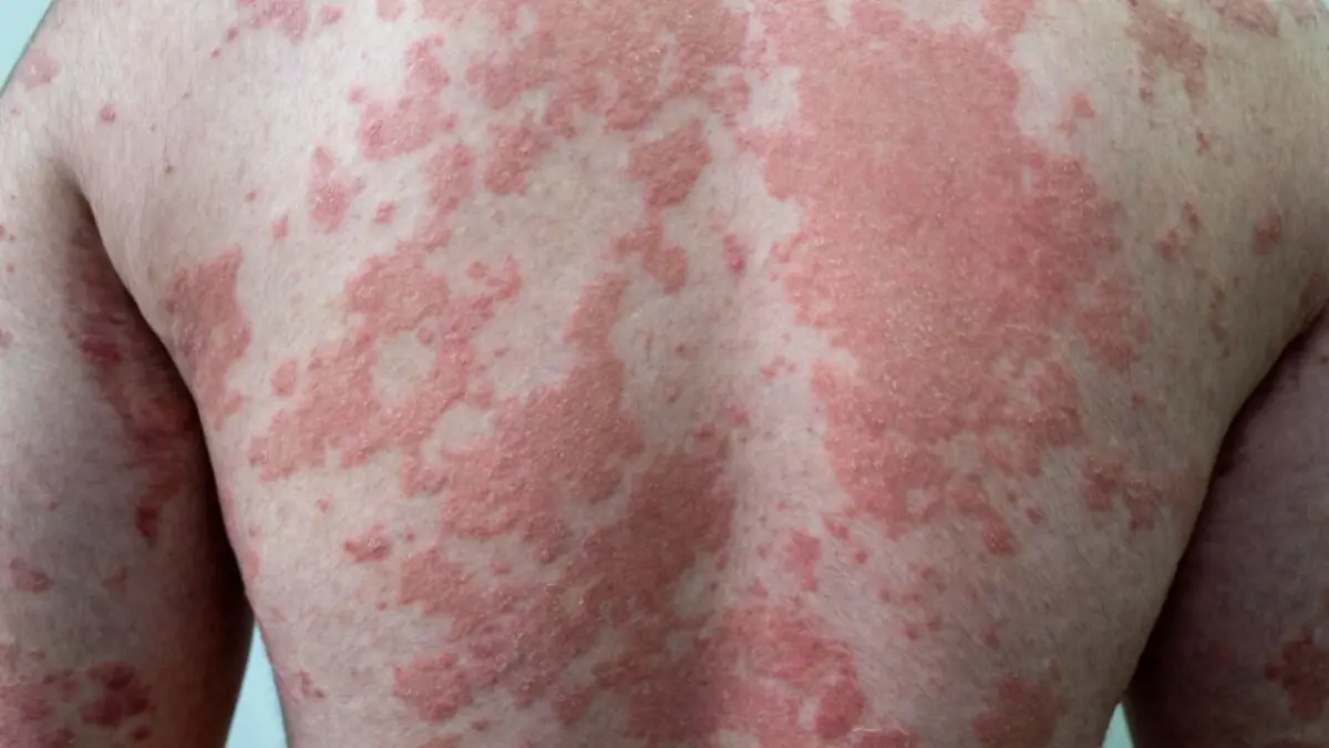 Psoriasis una enfermedad que impacta en la vida cotidiana del 60% de los pacientes