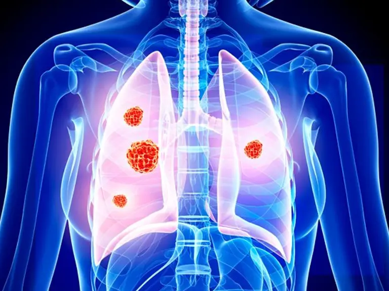 La OMS alerta sobre medicamento falsificado para tratar el cáncer de pulmón no microcítico