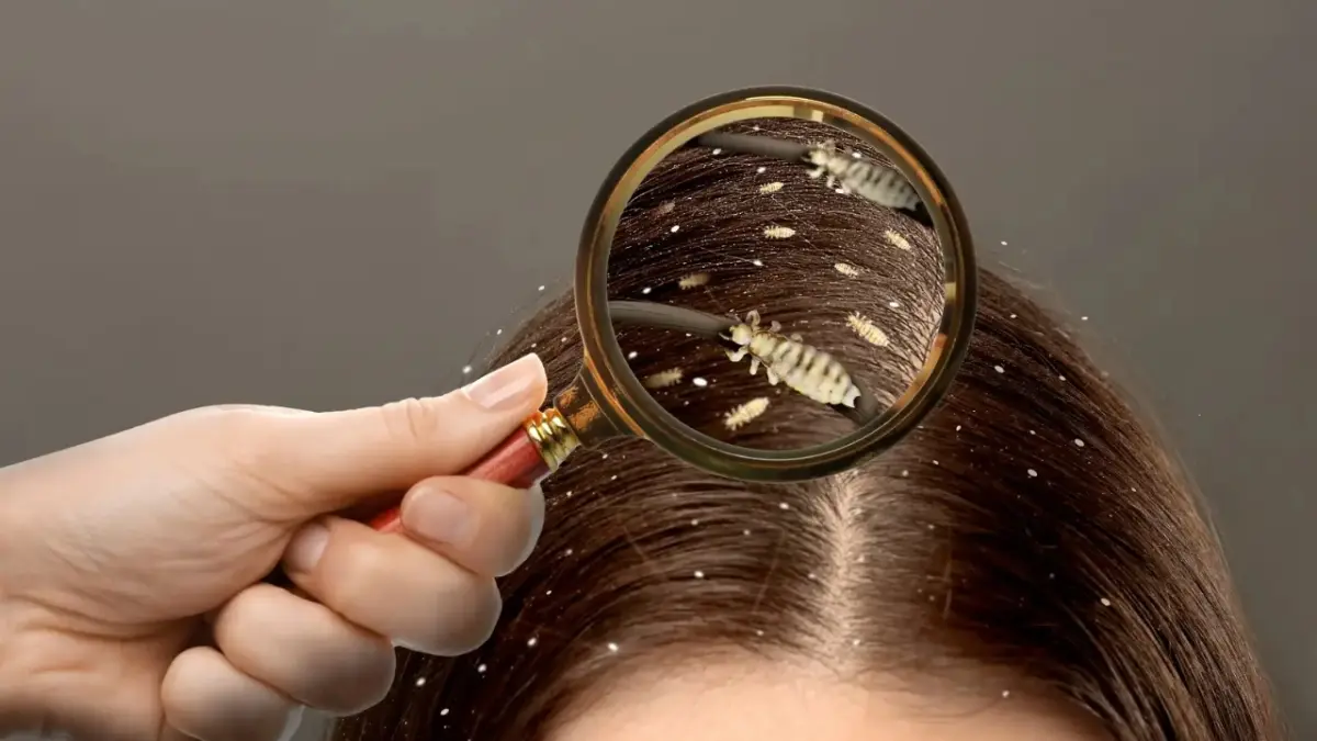 Cómo tratar y prevenir el contagio de piojos en los niños