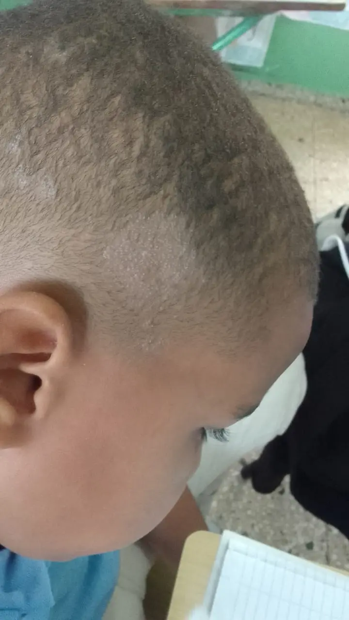 ¡Piojos y hongos! Brote afecta escuela en Santiago y desata preocupación