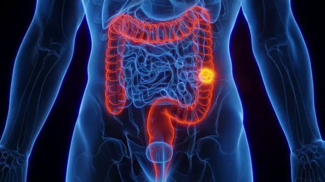 Aumento de cáncer colorrectal en menores de 50 años 