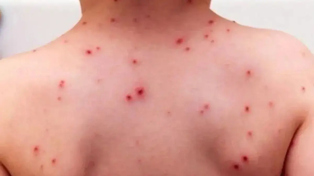 Salud Pública intensifica las medidas ante brote de sarampión en Estados Unidos