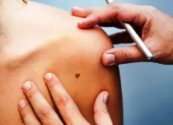 VPH una de las infecciones de transmisión sexual más comunes