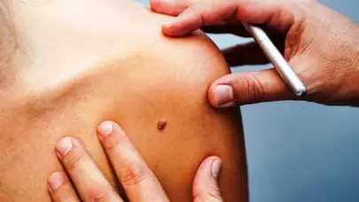 VPH una de las infecciones de transmisión sexual más comunes