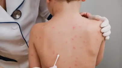 EE.UU. notificó a OMS brote de sarampión, cumpliendo el Reglamento Sanitario Internacional