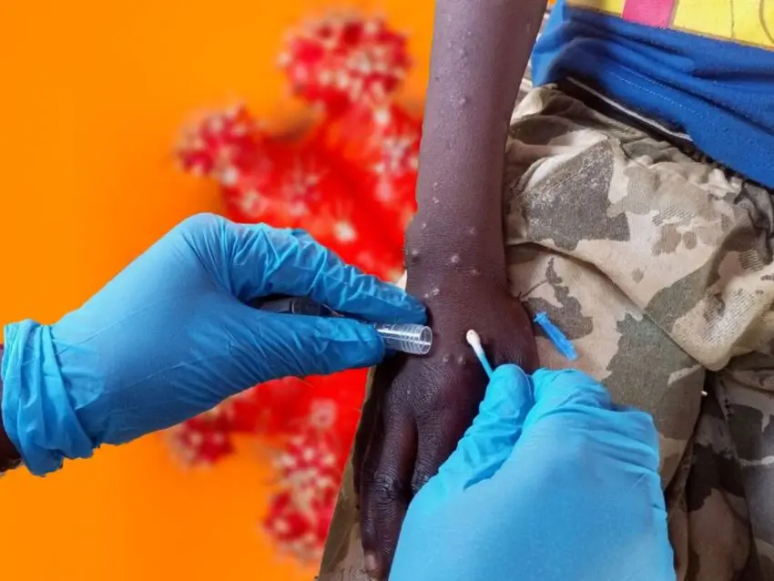 África registra más de 122.000 casos y 1.730 muertes por mpox desde 2024