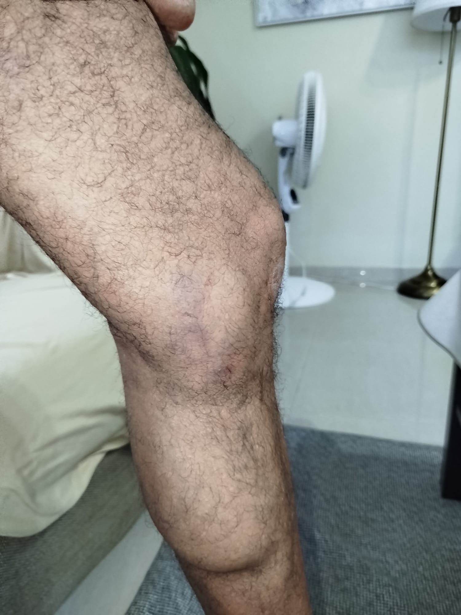 Rodilla inflamada en casa