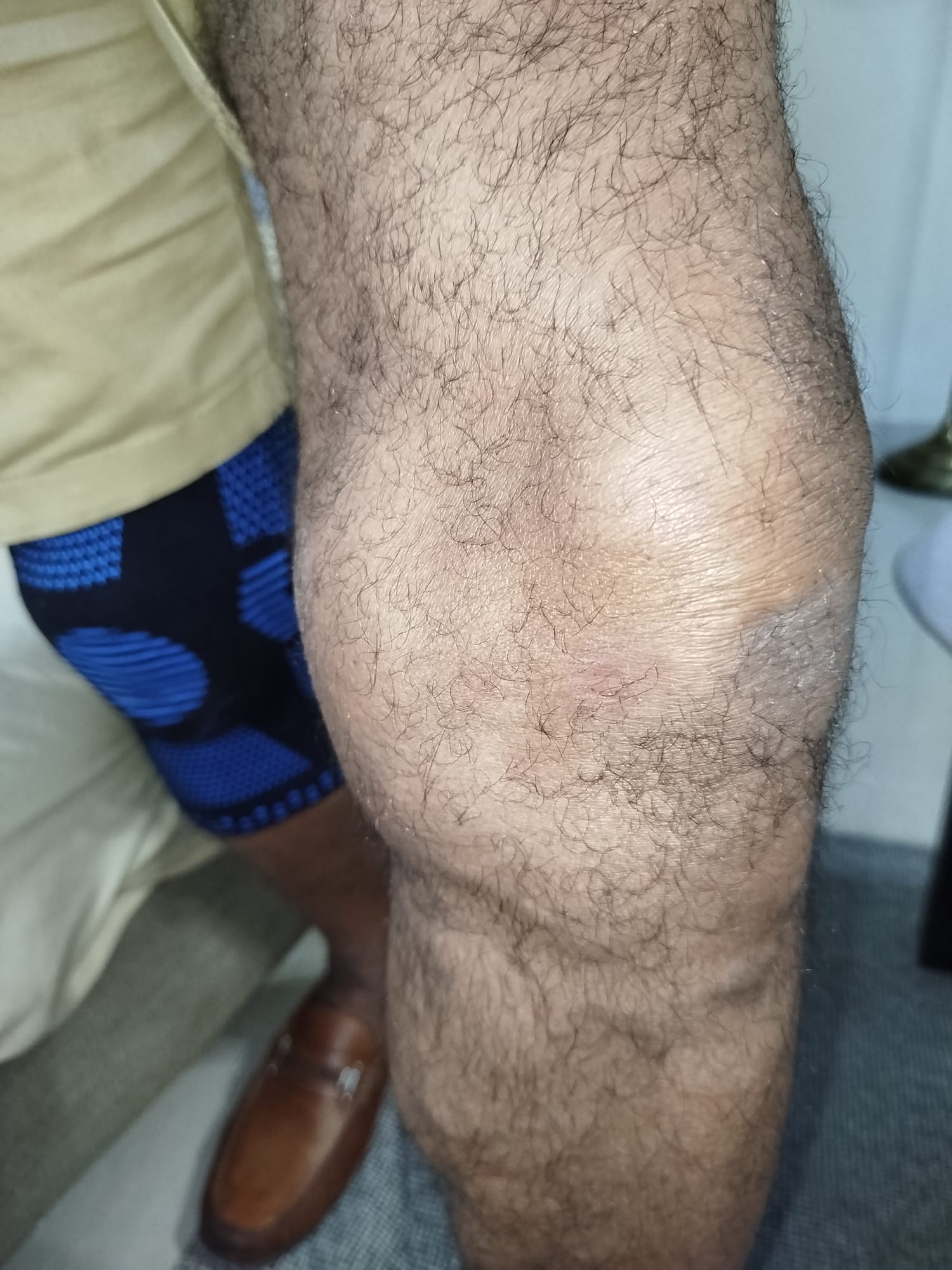Pierna masculina con cicatriz visible en rodilla