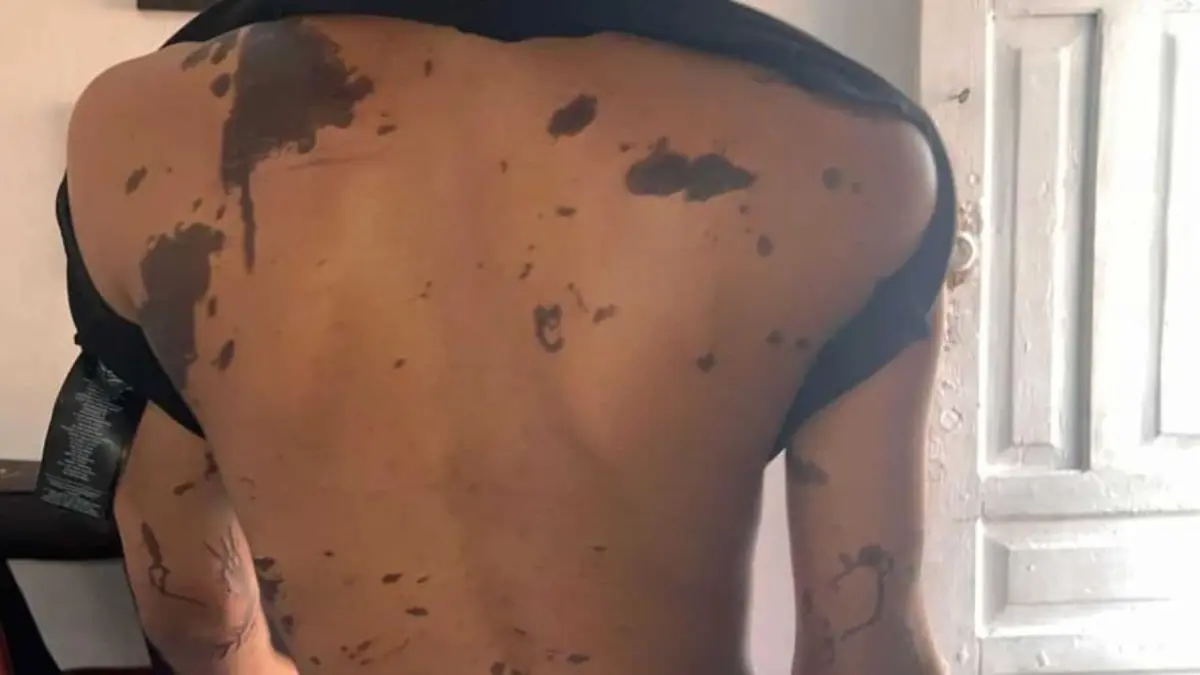 Atacan con ácido del diablo a madre e hija en Capotillo