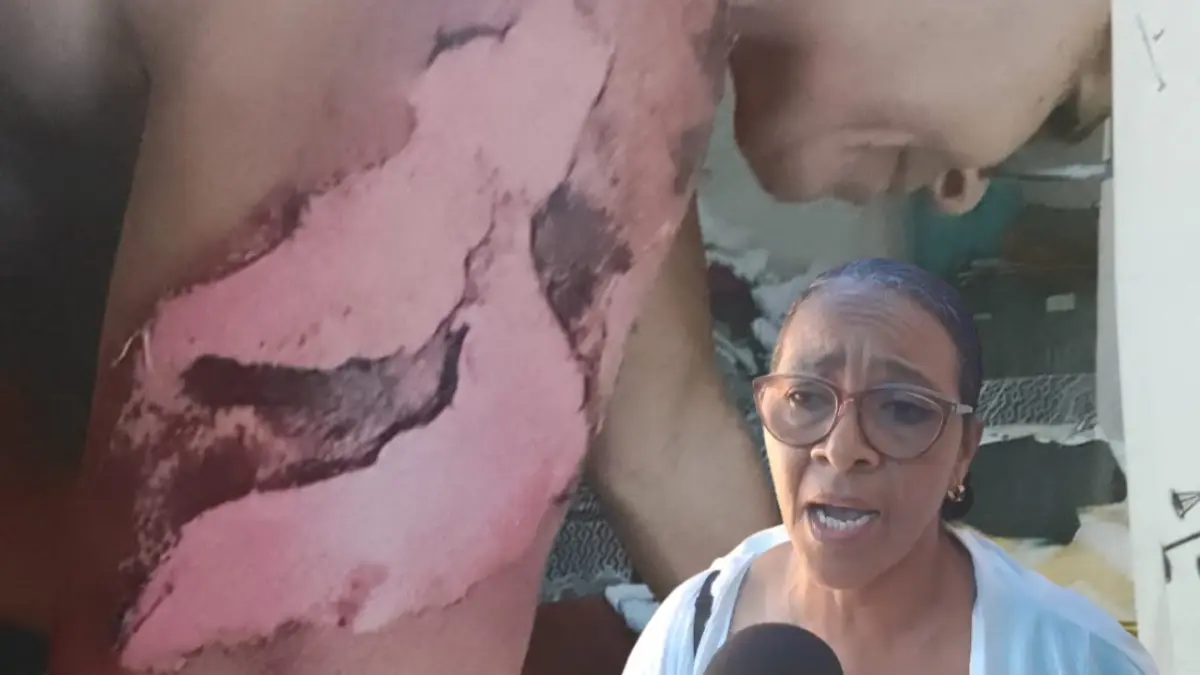 Profesora denuncia fue quemada con agua caliente por una abogada y teme por su vida