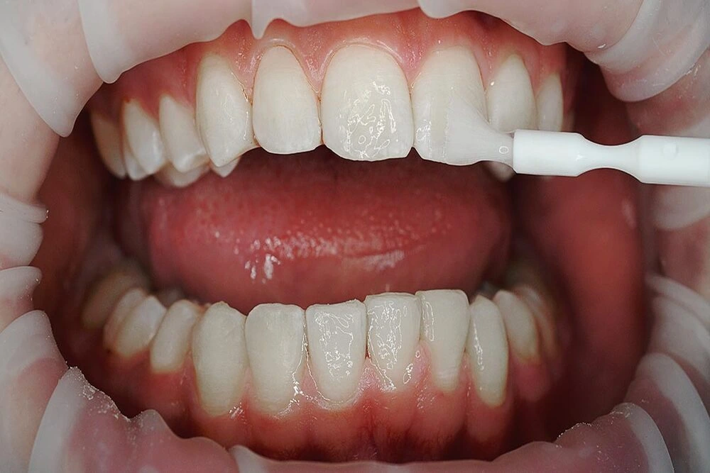 Aplicación de barniz dental en esmalte de dientes