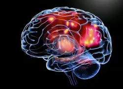 Aumentan casos de epilepsia en RD