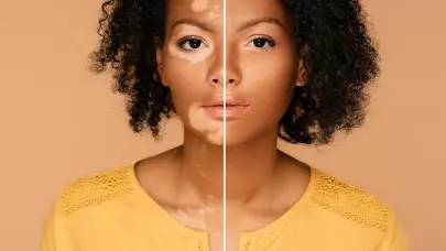 El vitiligo no es contagioso, especialistas llaman a erradicar mitos sobre esta condición de la piel