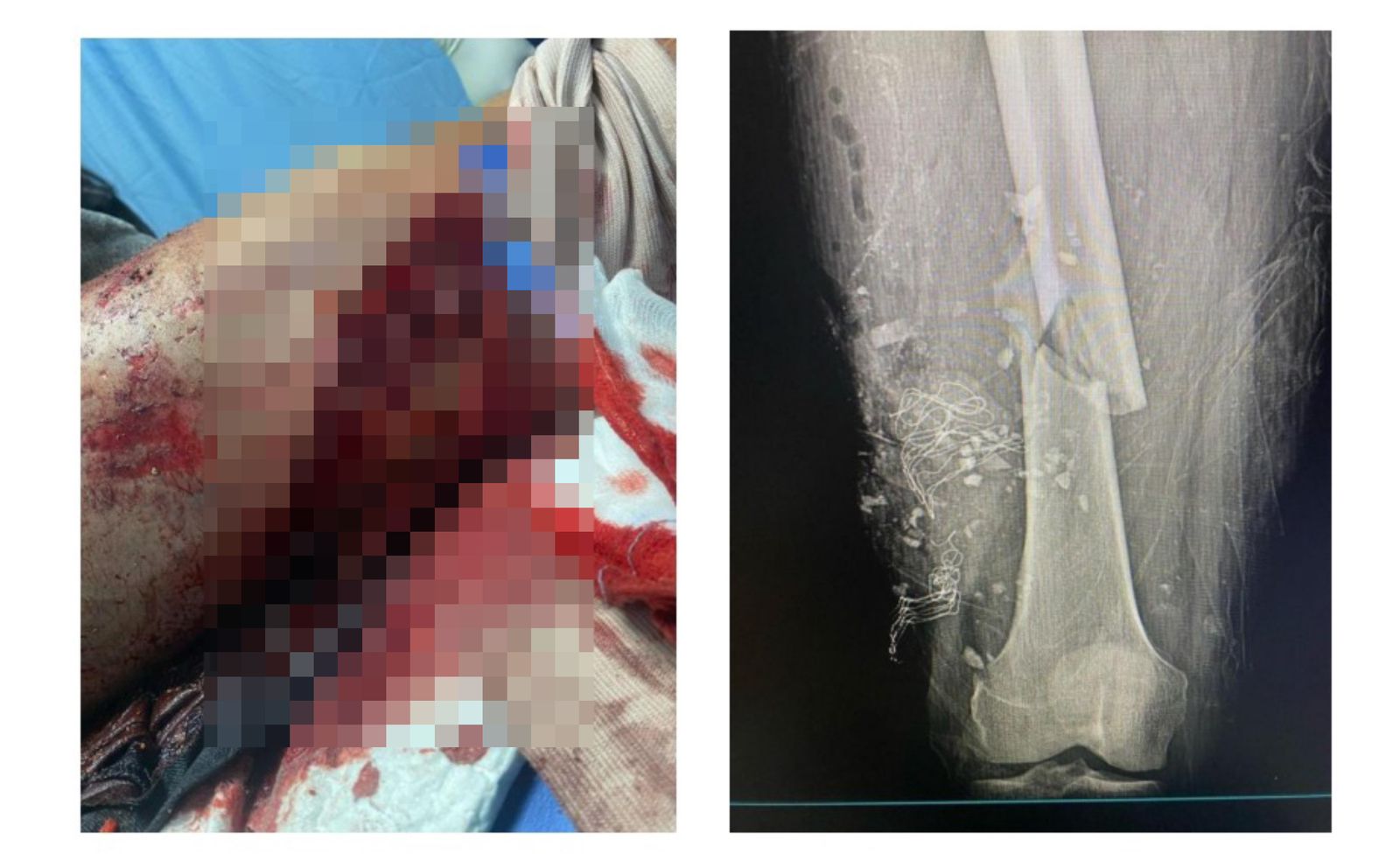 Herida y radiografía de fractura ósea grave