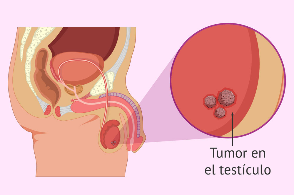 Ilustración de tumor testicular en sección masculina.