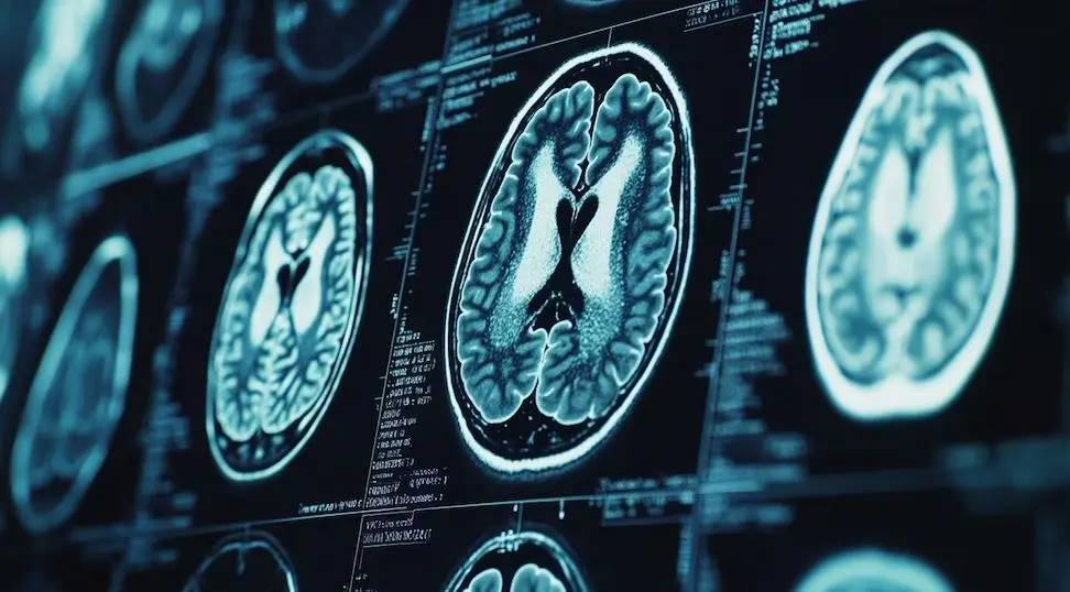 Cómo funciona la inteligencia artificial que puede detectar Alzheimer y otras demencias con una sola imagen