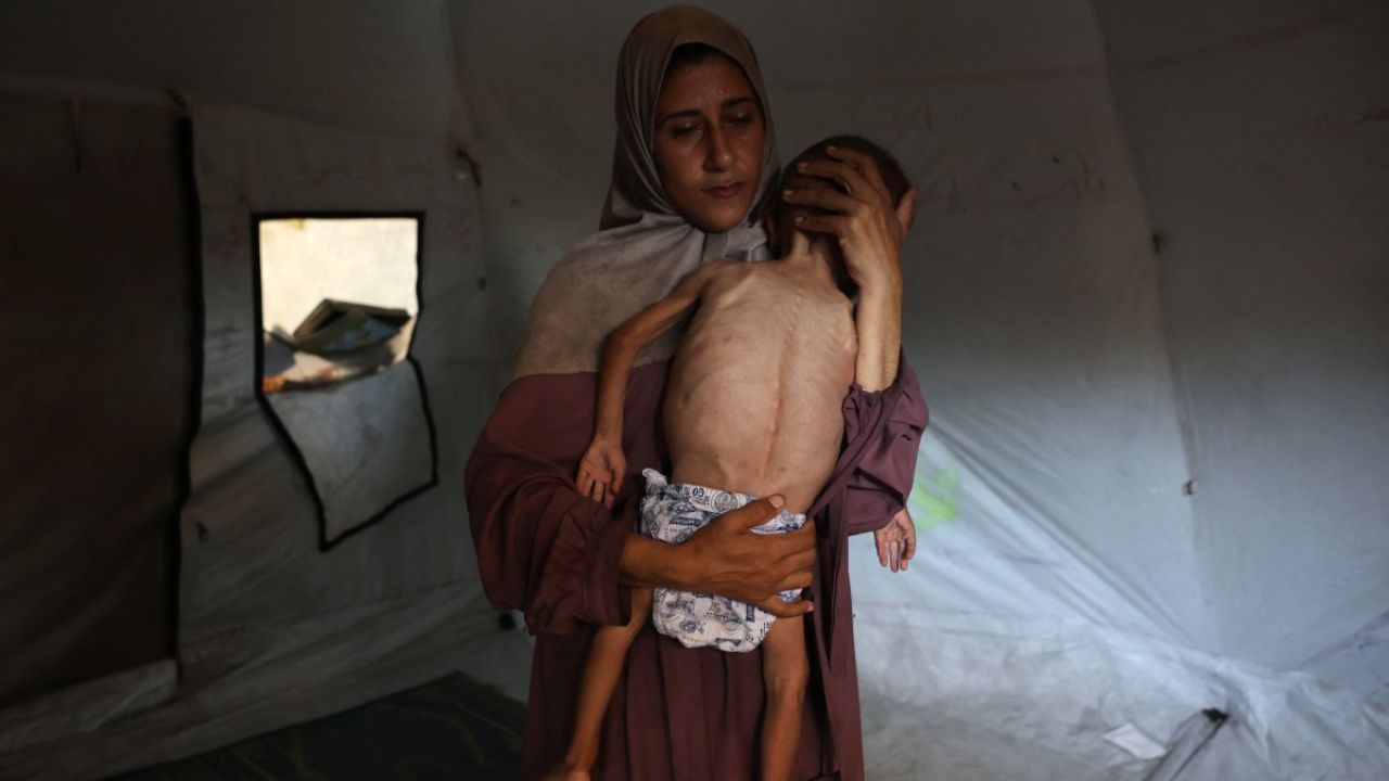 Mujer sostiene niño en situación de desnutrición